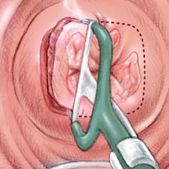 Loop Electrosurgical Excision Procedure