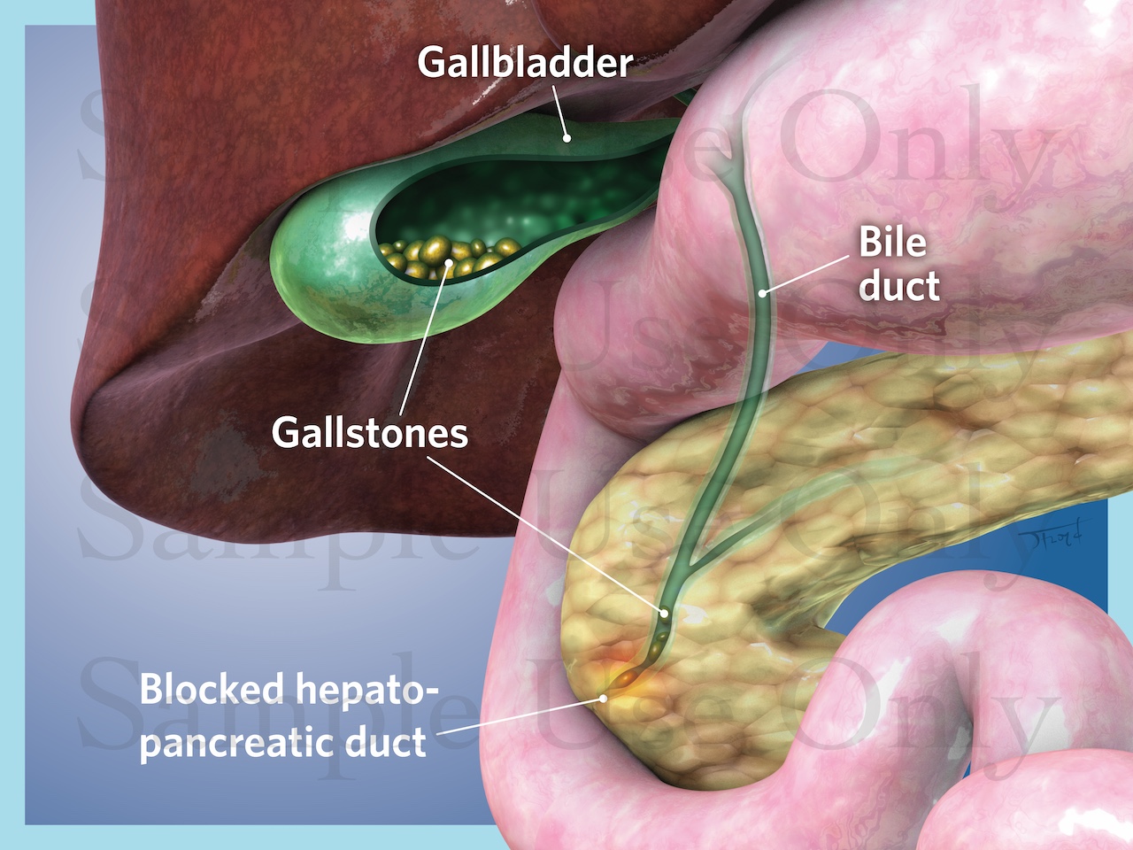 Medical Illustration Sample: Cholelithiasis