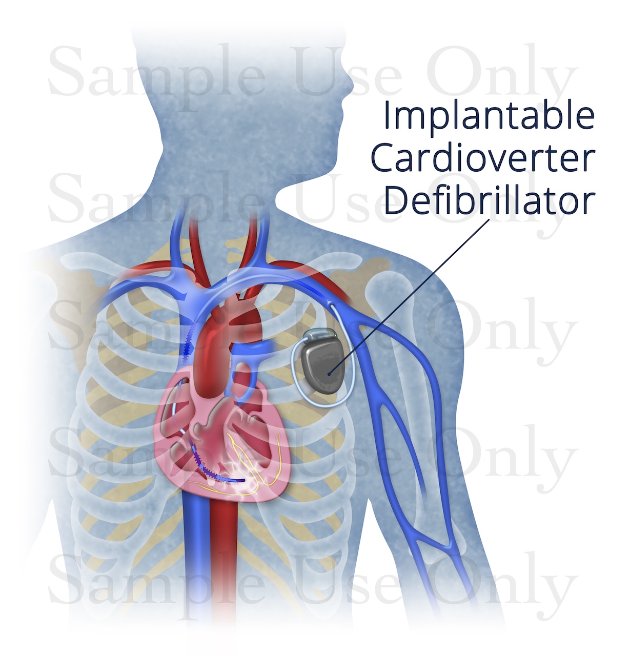 Medical Illustration Sample: Implantable Cardioverter Defibrillator