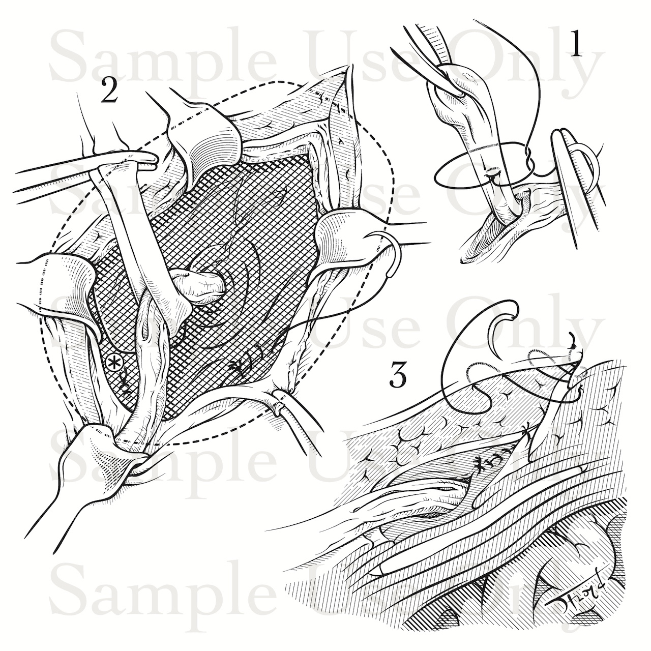 Medical Illustration Sample: Inguinal Hernia Repair