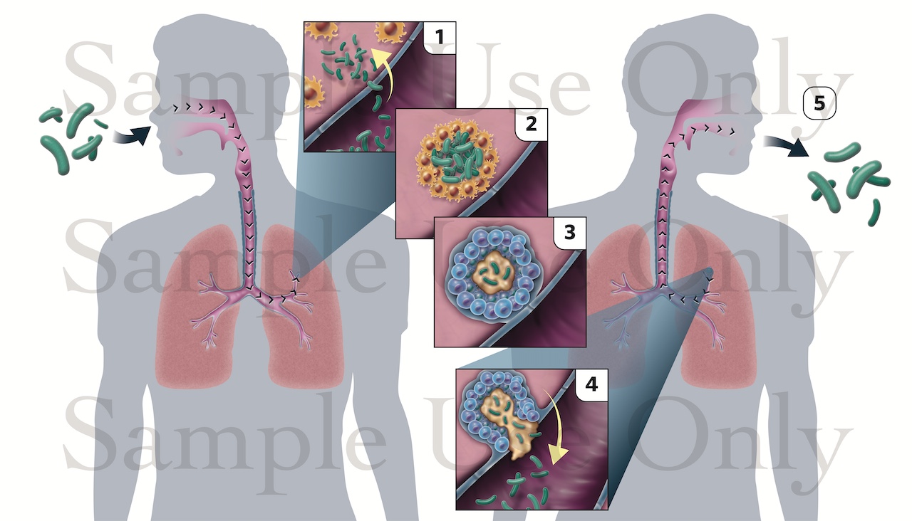 Medical Illustration Sample: The Spread of Tuberculosis