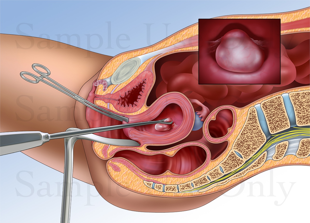 Medical Illustration Sample: Uterine Fibroid Removal